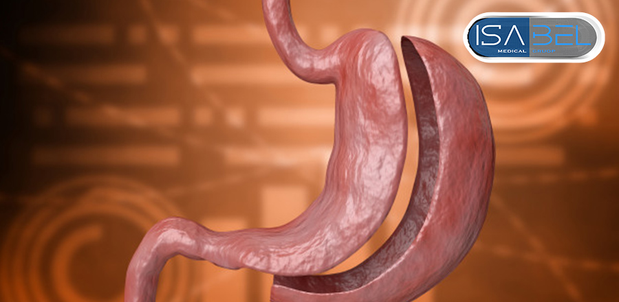 Sleeve gastrectomy from A to Z
